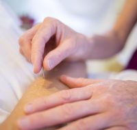 acupuncture-5126777_1280